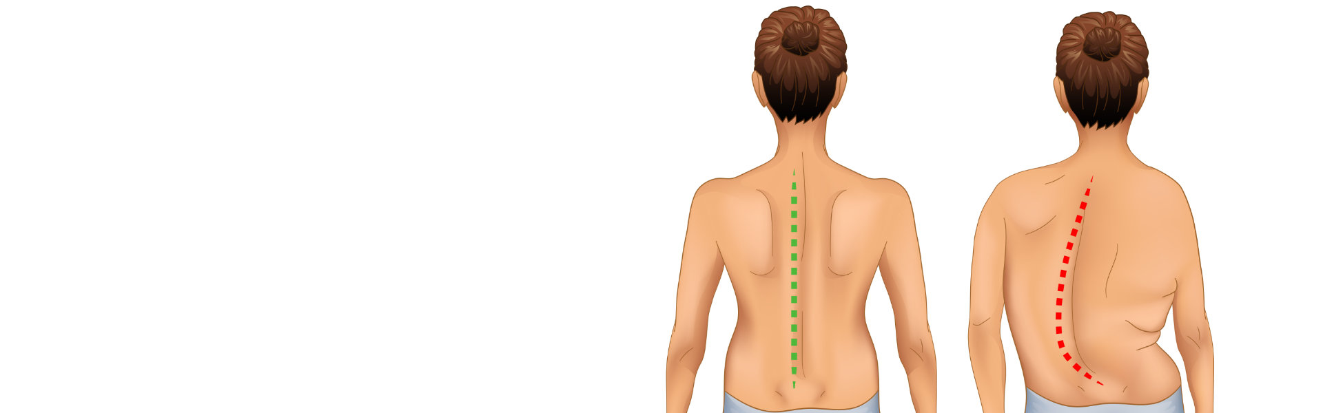 spine scoliosis treatment in dubai